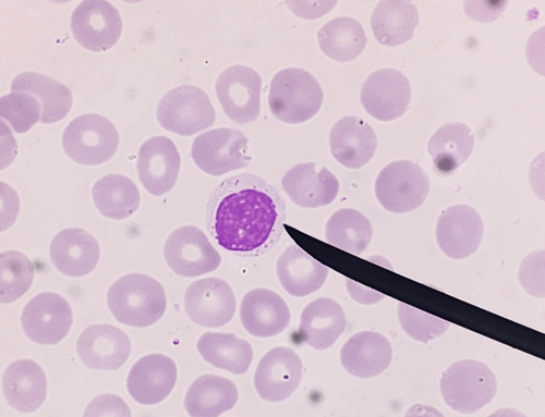 Le cellule “natural killer” potenziate: la nuova frontiera contro le malattie autoimmuni