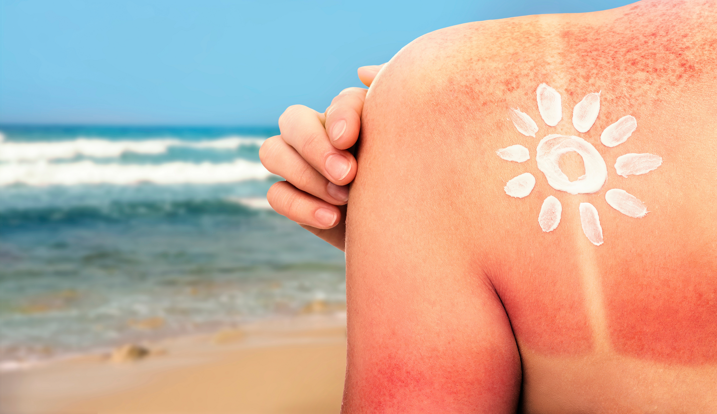 Sole e melanoma cosa dice davvero la scienza sulla prevenzione