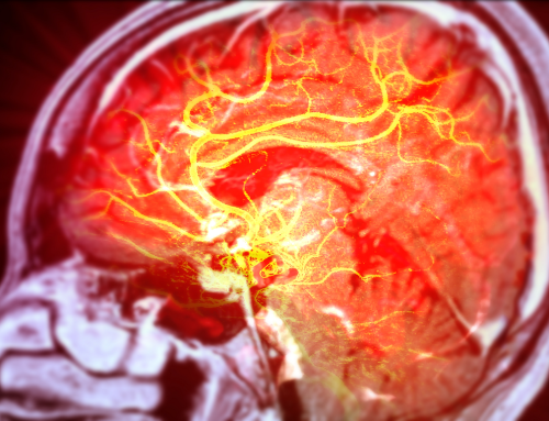 Ictus e neuroplasticità: come il cervello si riorganizza dopo il danno