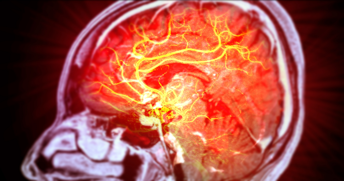 Ictus e neuroplasticità come il cervello si riorganizza dopo il danno