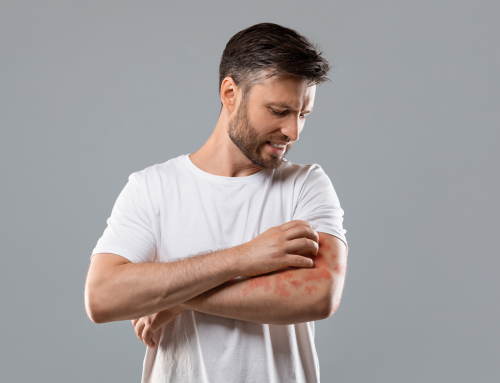 Psoriasi: individuato un nuovo meccanismo coinvolto nell’infiammazione